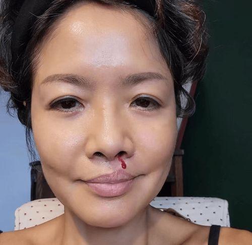 明星面瘫有哪些,揭秘他们背后的故事与挑战